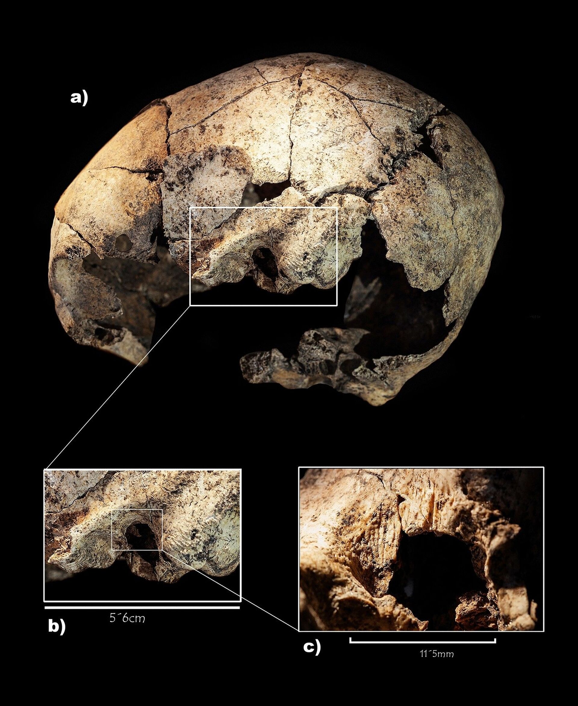 Detalhe da perfuração feita durante cirurgia em crânio de 5.300 anos de idade - Sputnik Brasil, 1920, 17.02.2022