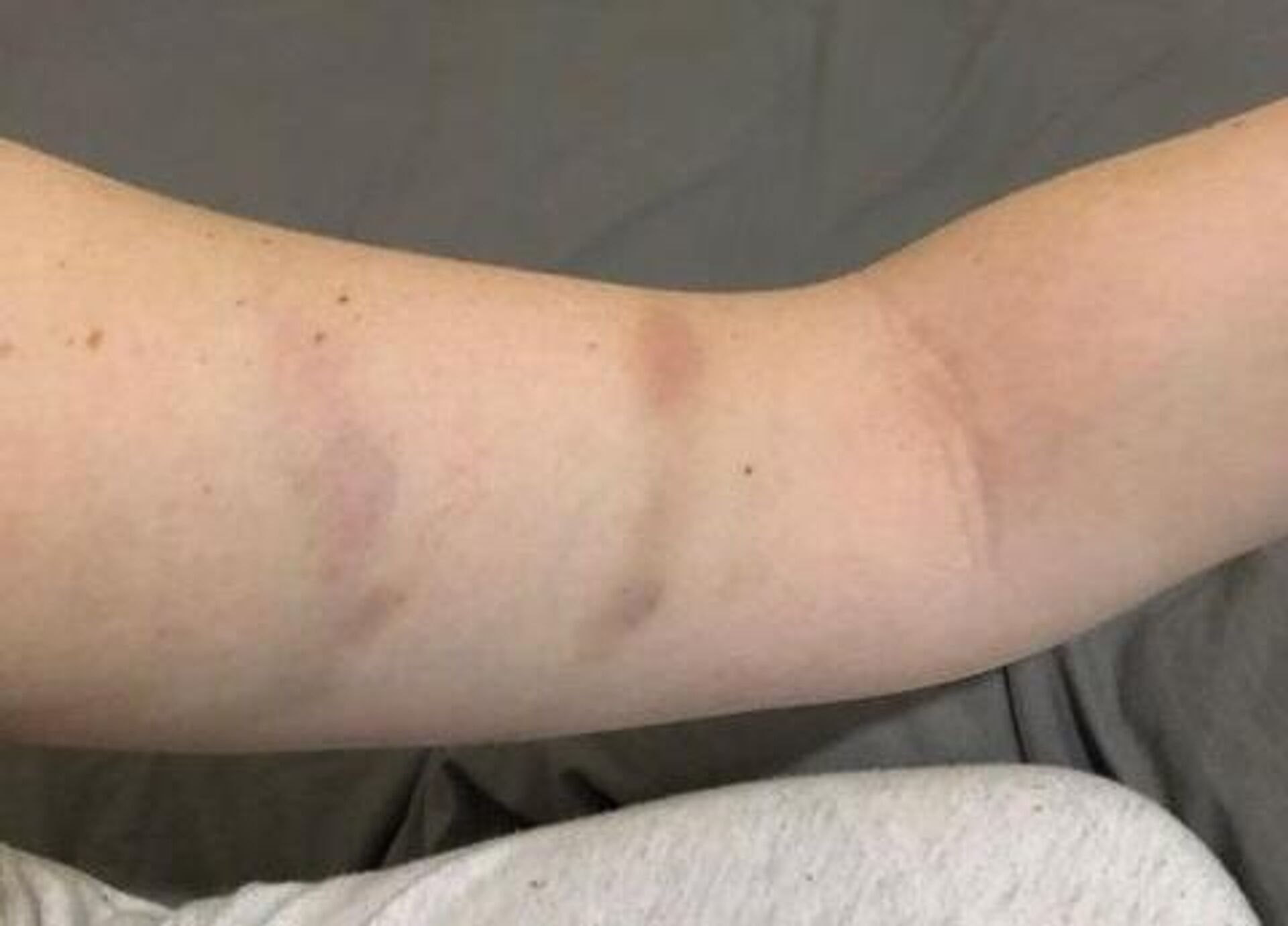 Júlia Taranto mostra alguns dos hematomas no seu braço após as agressões dos seguranças - Sputnik Brasil, 1920, 23.02.2022