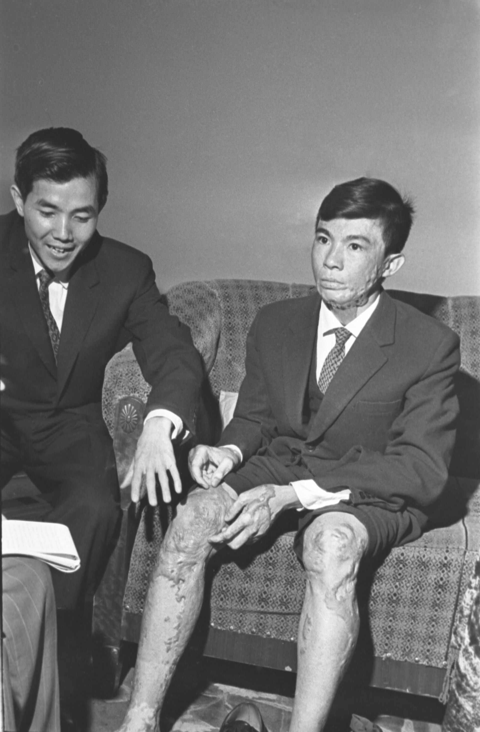 Vítimas da Guerra do Vietnã (1957-1975). O jovem sul-vietnamita Thai Binh Zang ficou com essas queimaduras terríveis após a explosão de uma bomba napalm norte-americana, 15 de dezembro de 1967 - Sputnik Brasil, 1920, 10.08.2022