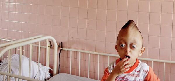 Nesta foto, registrada em 2005, aparece Xuan Minh, um garoto de três anos no Hospital Tu Du. O garoto sofreu alterações genéticas devido ao uso do agente laranja no Vietnã pelas tropas dos EUA. - Sputnik Brasil