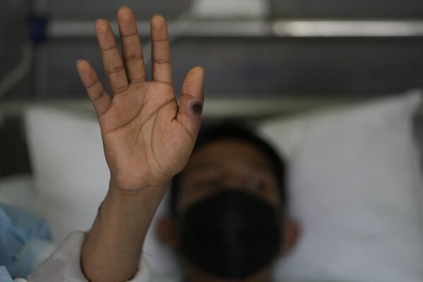 Paciente mostra as mãos com marca causada pela varíola dos macacos em um hospital em Lima, Peru. Maio de 2022 foi marcado pelo surto deste vírus raro, detectado pela primeira vez em 1958, em todo o mundo. - Sputnik Brasil
