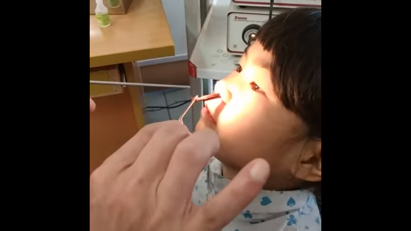 Sanguessuga é removida de nariz de garota no Vietnã - Sputnik Brasil